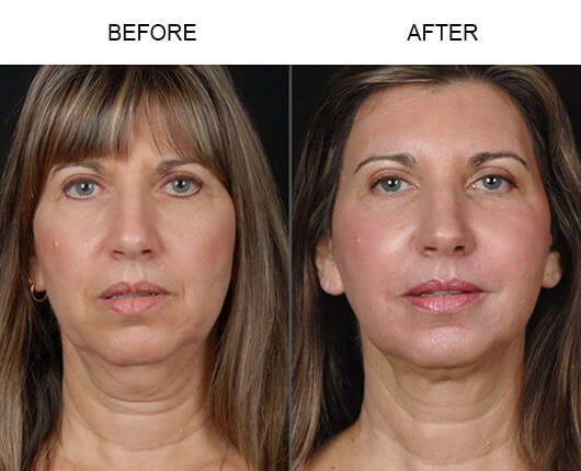 Laser Facelift Before And After