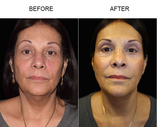 LazerLift® Treatment Results LazerLift® Treatment Results
