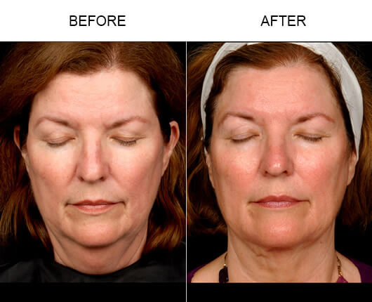 Laser Facelift Treatment Results Laser Facelift Treatment Results