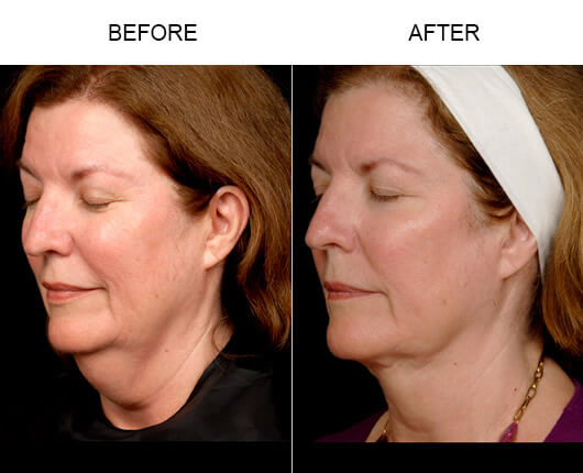 Laser Facelift Procedure Results