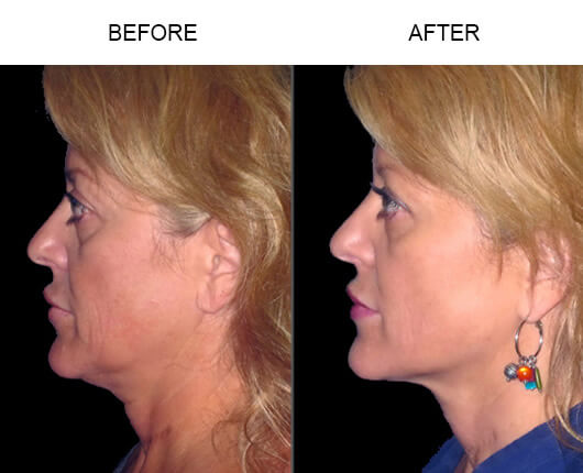 LazerLift® Before And After LazerLift® Before And After