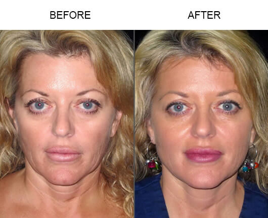 LazerLift® Treatment Before And After LazerLift® Treatment Before And After