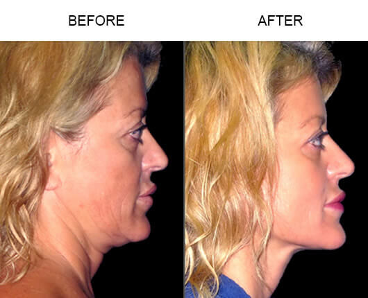 LazerLift® Procedure Before And After LazerLift® Procedure Before And After