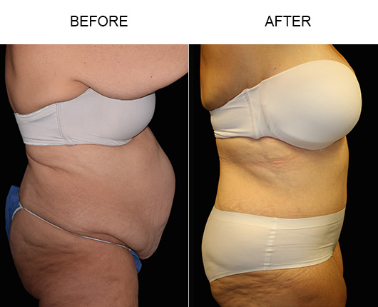 LowCut Tummy Tuck Before And After