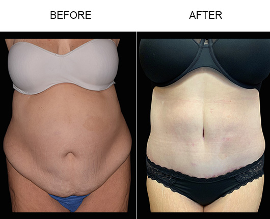 LowCut Tummy Tuck Orlando