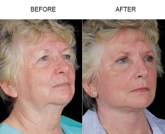 Mini Facelift  Before And After 