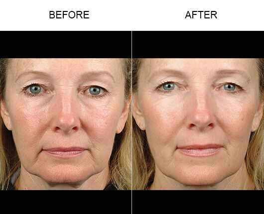 Thermage® Before And After