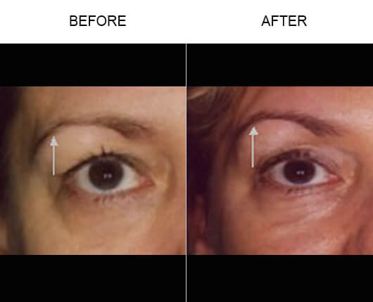 Thermage® Facial Treatment Results