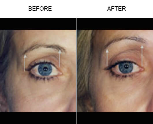 Thermage® Facial Treatment Before And After