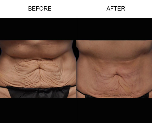 Laser skin sales tightening stomach