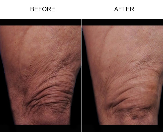 Skin Tightening Before and After