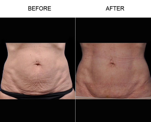 Skin Tightening Before & After