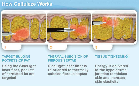 Cellulite Removal With Cellulaze™ Cellulite Removal With Cellulaze™
